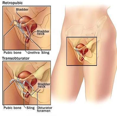 drawing of female anatomy, bladder