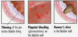 anatomical drawings of bladder lining, pinpoint bleeding, and Hunner's ulcer