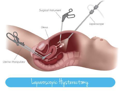 diagram of laparoscopic hysterectomy