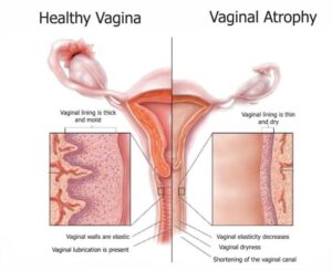 anatomy drawing of healthy vagina vs. vaginal atrophy