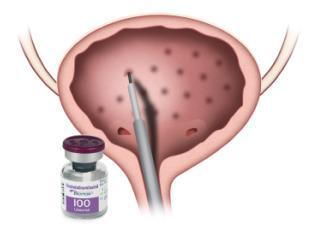 drawing of sacral neuromodulation therapy